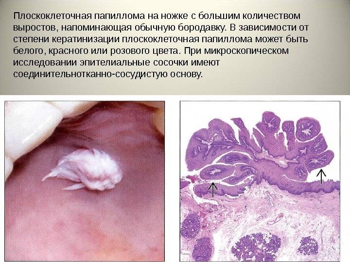 Плоскоклеточная папиллома кожи на лице и теле: основные симптомы, причины возникновения, лечение, прогноз