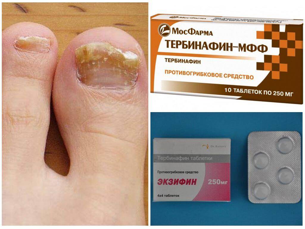 Топ 24 средство от грибка ногтей на ногах (недорогое и эффективное взрослым)