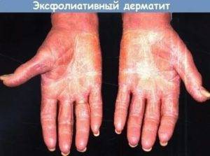 Лечение аллергического дерматита у взрослых: фото, мази, народные средства