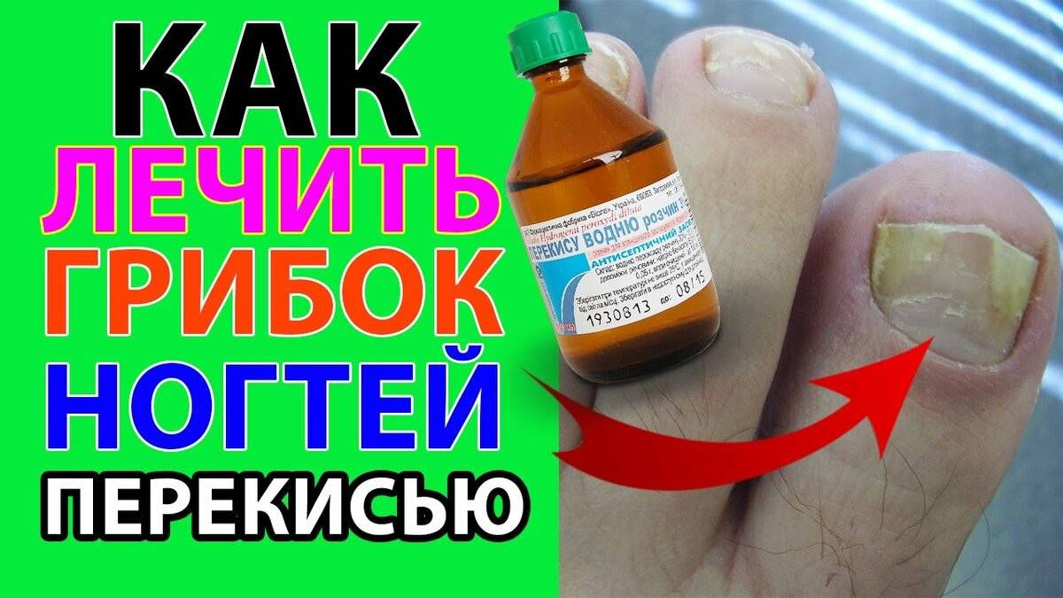 Лечение грибка ногтей на ногах перекисью водорода: ванночки и примочки с содой