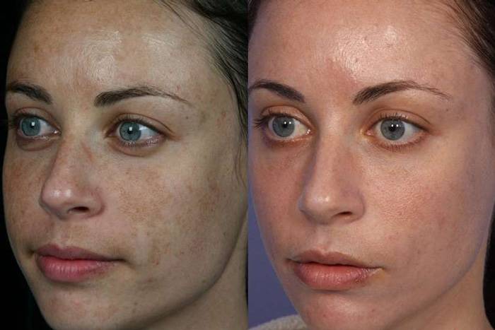 Фотоомоложение кожи лица: плюсы и минусы, эффект и уход после лазерной процедуры