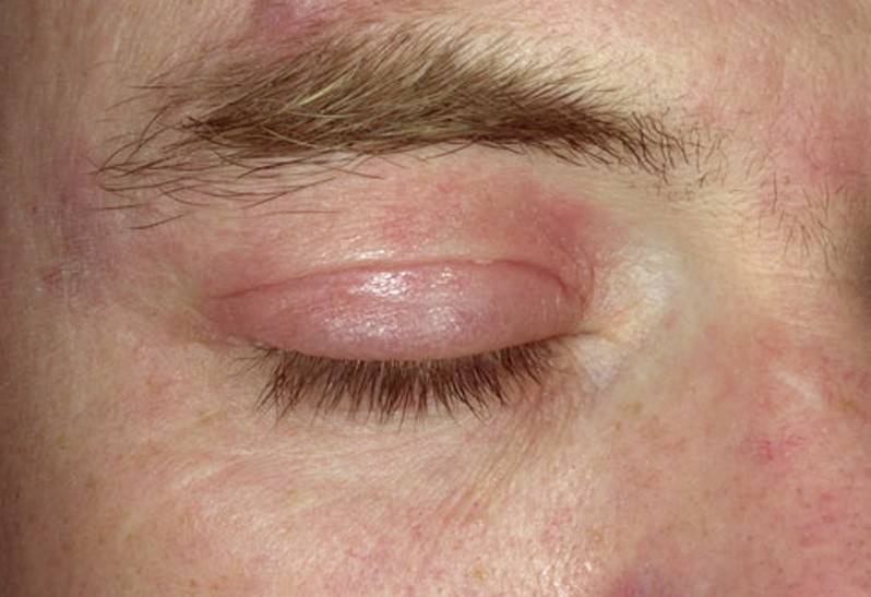Проявление псориаза на глазах! фото век, чем опасно заболевание? как правильно лечить?