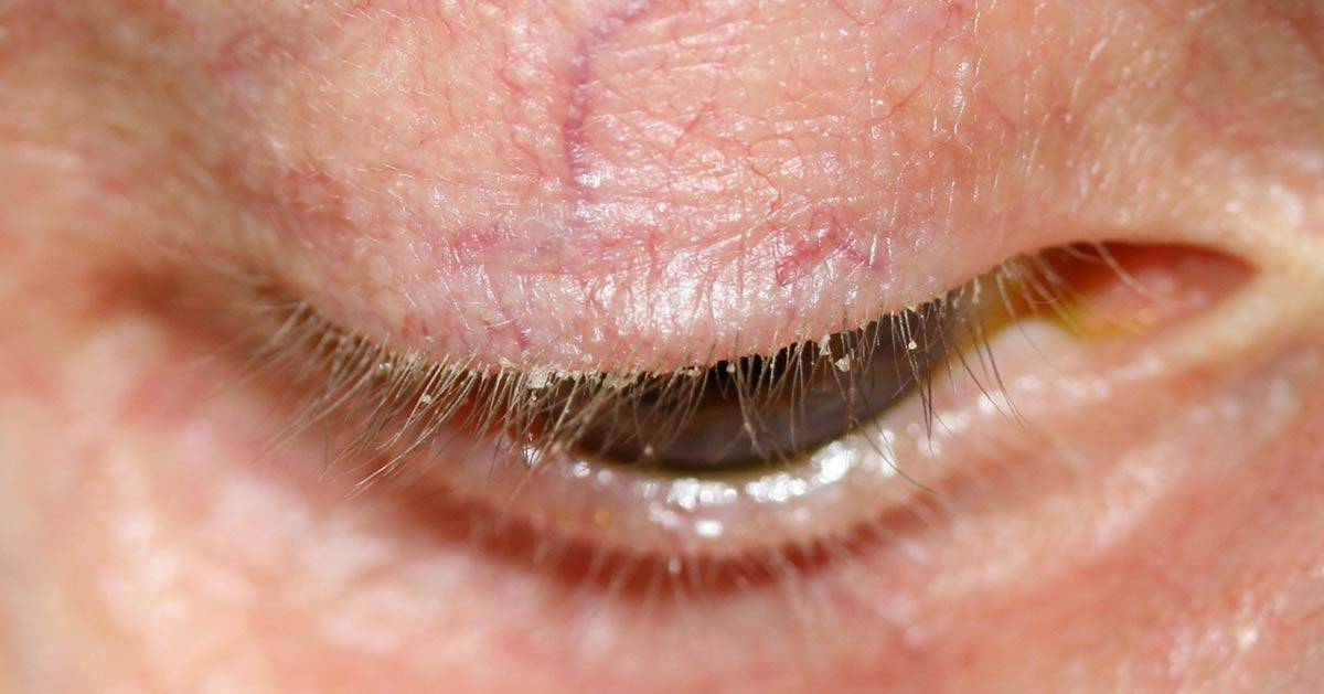 Как нужно лечить псориаз на глазах?