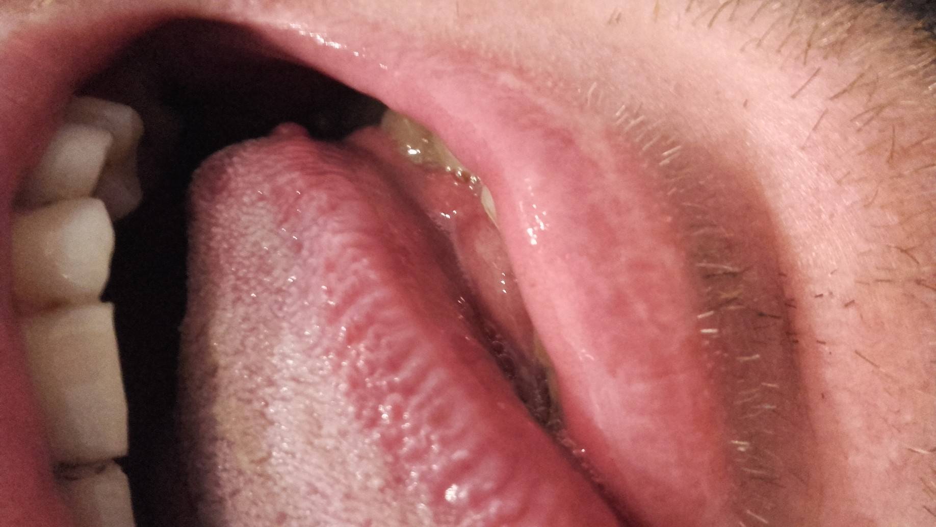 Папилломы во рту под языком и на щеке: к какому врачу обратиться, лечение, удаление