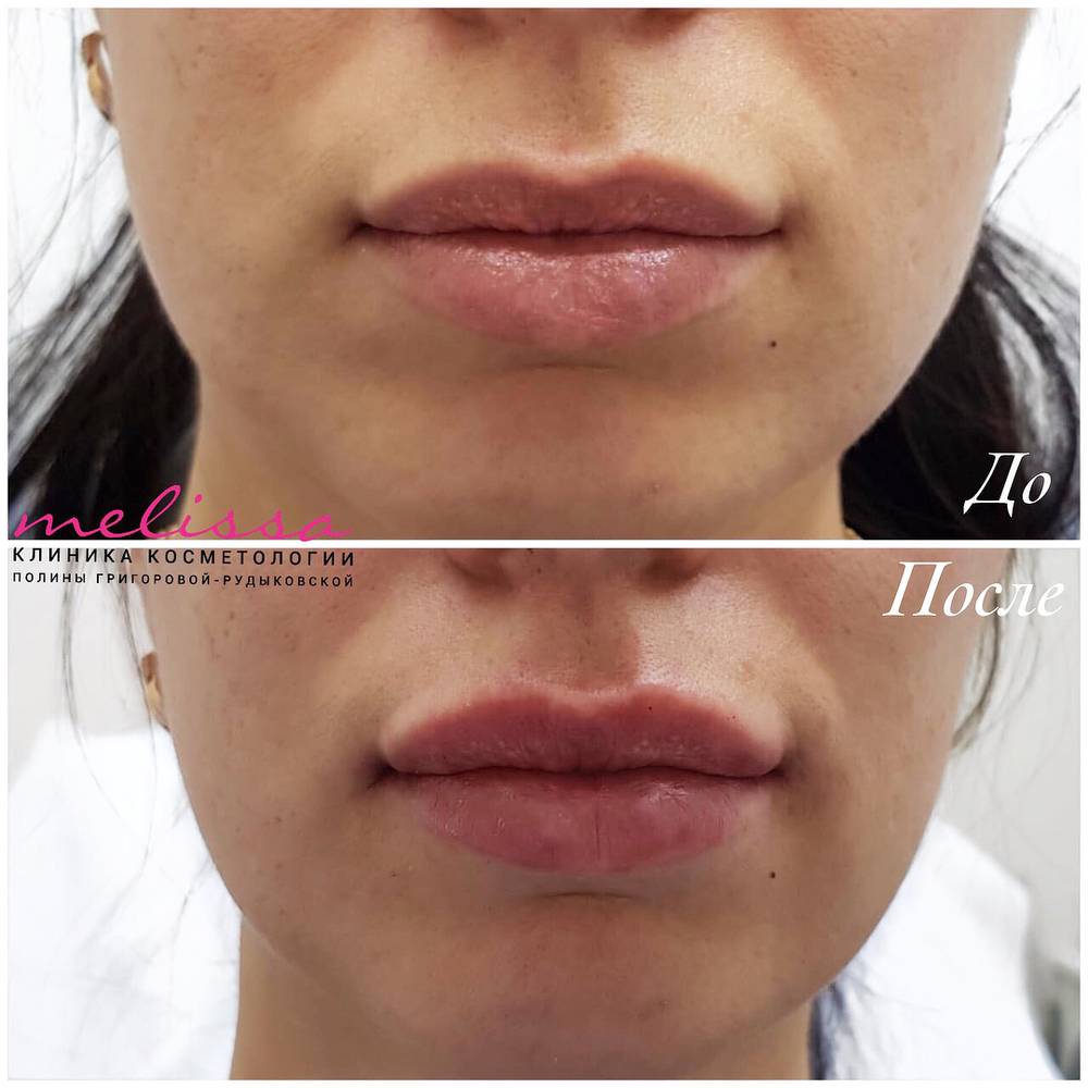 Сколько держится результат от увеличения губ липофилингом
