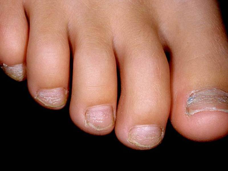 Псориаз ногтей на ногах и руках: симптомы и лечение в домашних условиях