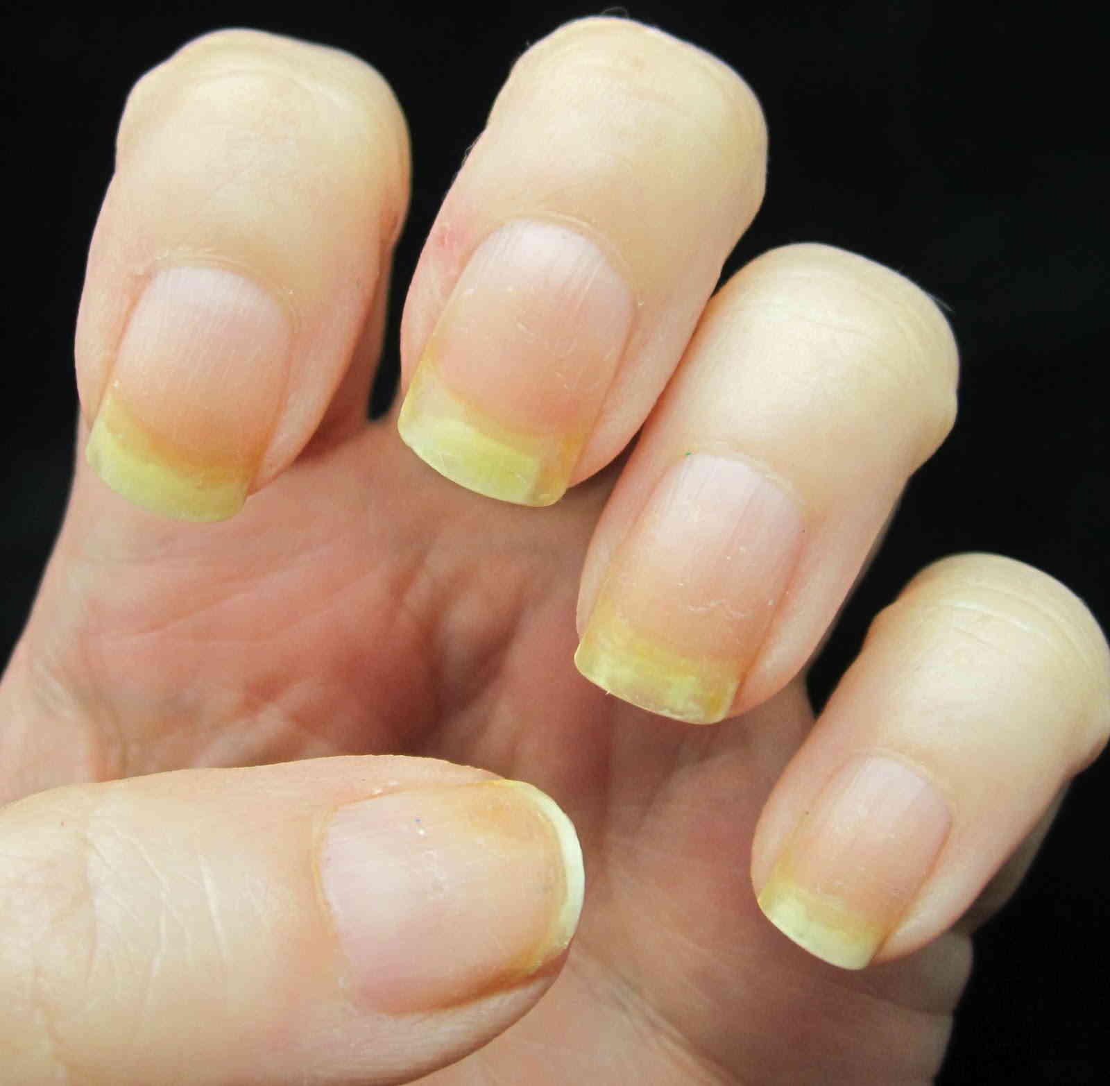 Желтые ногти на руках: причины, лечение