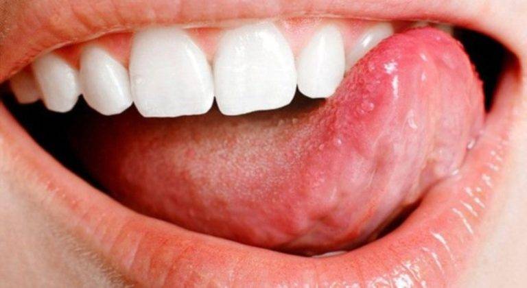 4 вида папиллом во рту (на языке, небё, десне) что это за болезнь