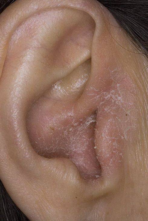 В ухе постоянно образуется корка белая. почему возникает перхоть в ушах? причины этого явления и лечение перхоти