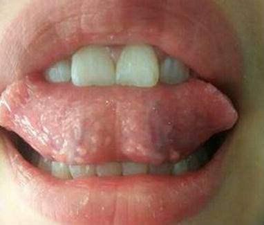 Папиллома под языком – лечение, фото, к какому врачу обратиться