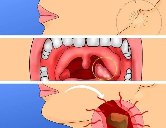 Папиллома в горле: места появления, методы удаления и лечение