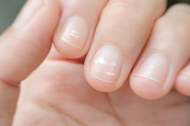 Диагностика по ногтям - признаки для определения заболевания по изменениям цвета, состояния и твердости