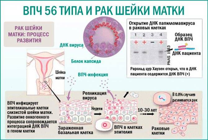 Папилломы шейки матки - виды, причины, симптомы, диагностика и лечение