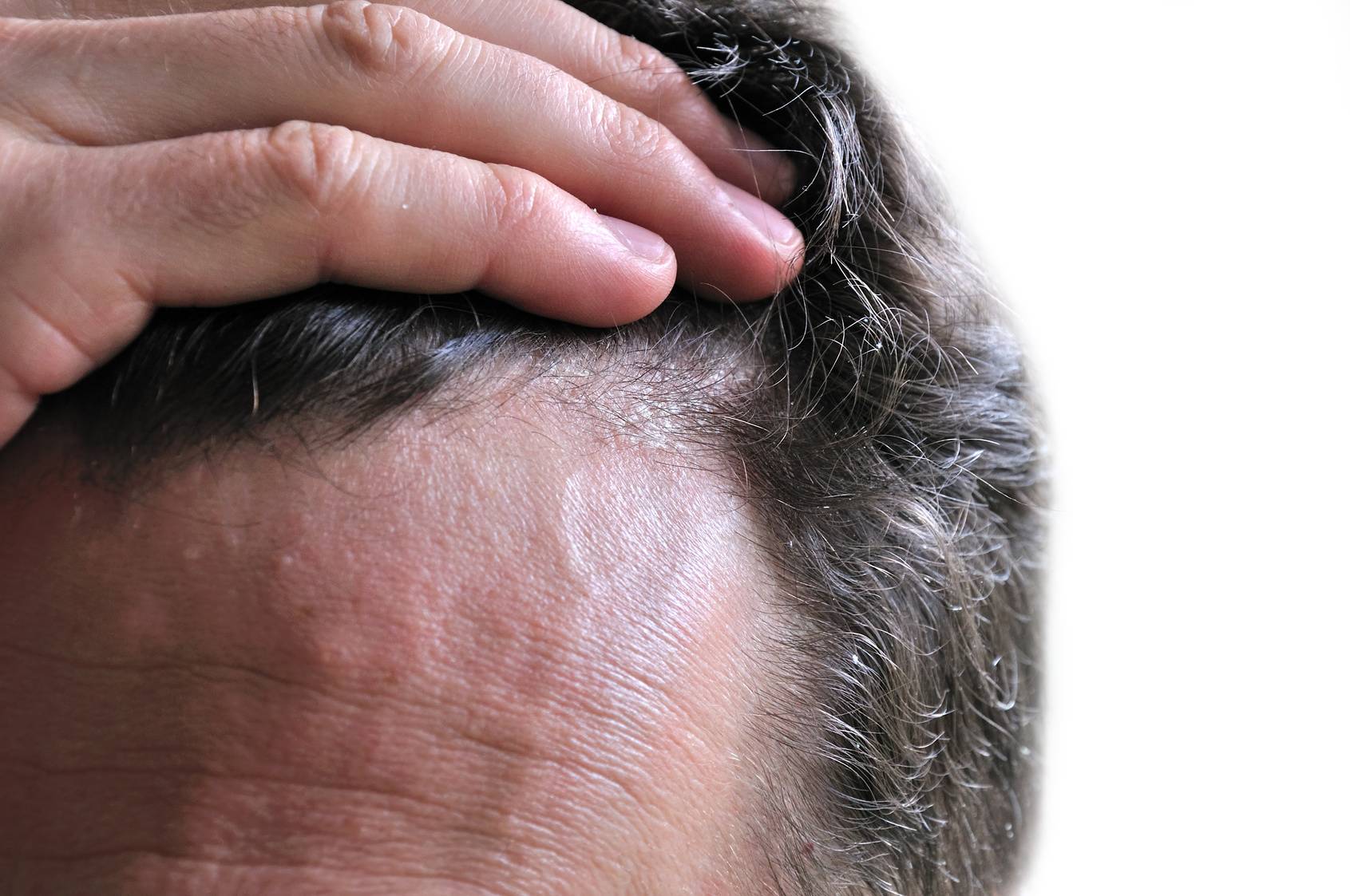 Псориаз кожи головы – лучшее лечение, симптомы и причины