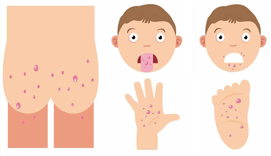Пузырчатый дерматит у детей лечение