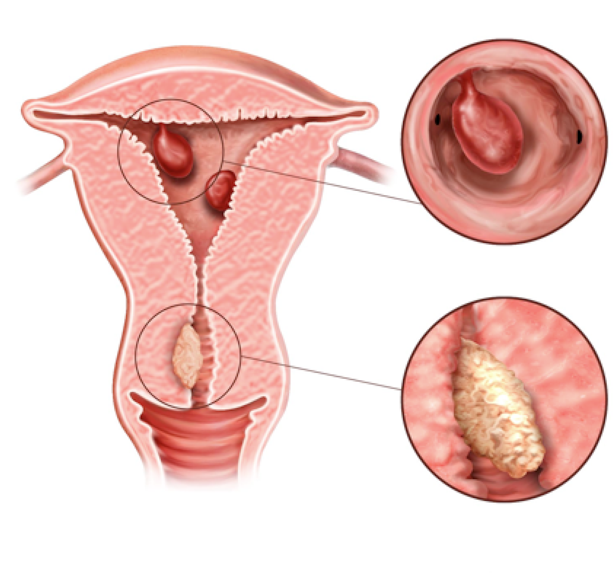 Что такое папиллома матки: причины возникновения, симптомы и лечение