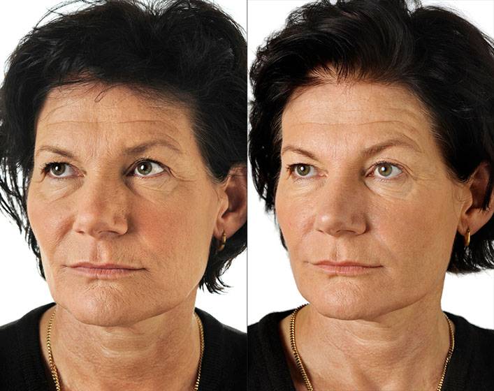 Что такое филлеры для лица: фото до и после контурной пластики и объемного моделирования, опасна ли процедура?