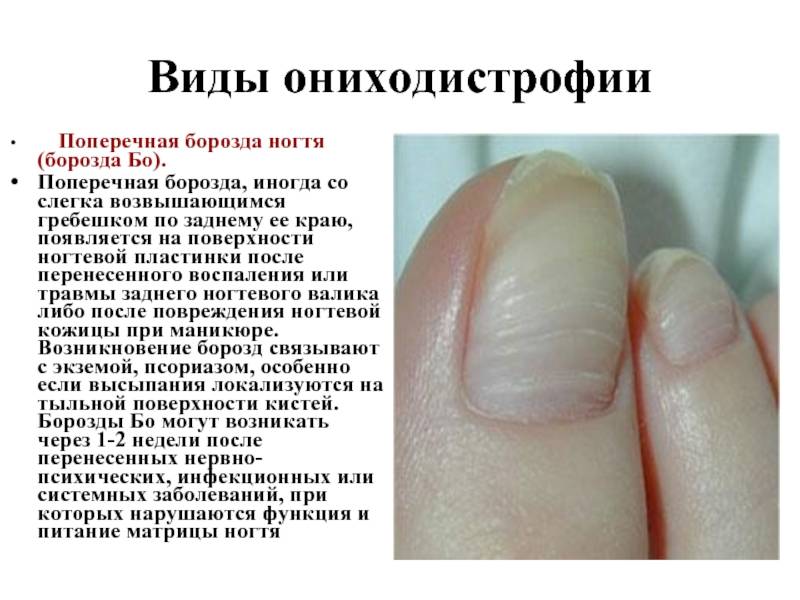 Белые полоски на ногтях ног или рук: причины у детей и взрослых, что делать