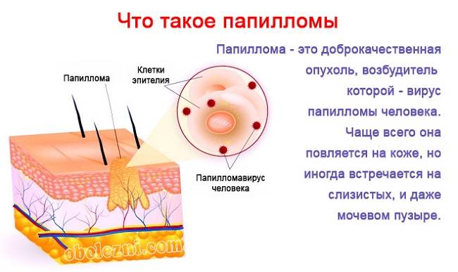 Симптомы и лечение плоскоклеточных папиллом с гиперкератозом