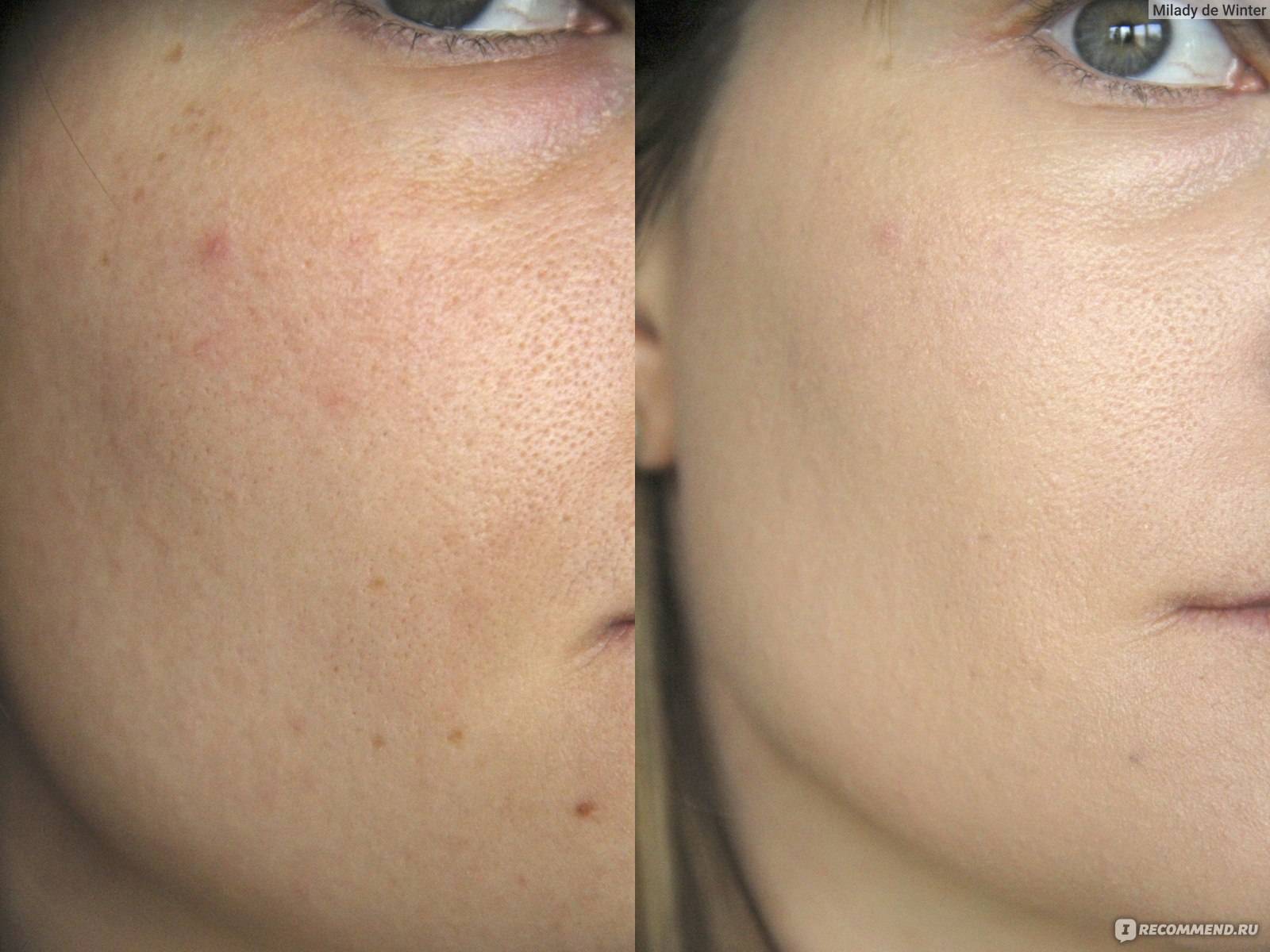 Bb glow treatment, эффект тонального крема на 1 год: что это такое за процедура в косметологии, как делать, можно ли в домашних условиях, фото до и после би би глоу