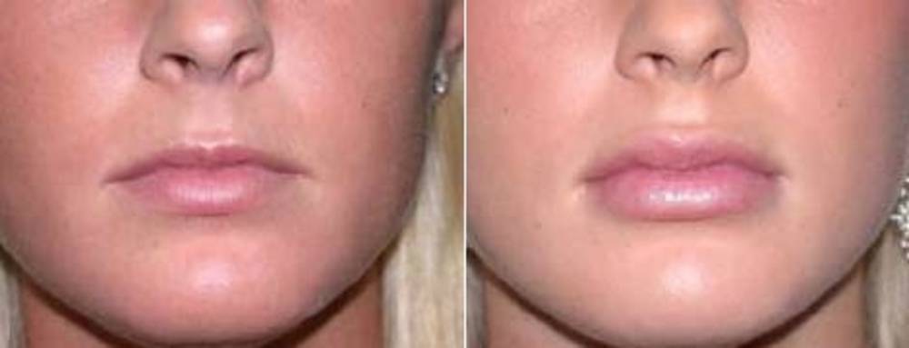 Липофилинг губ подарит чувственные (а главное!) натуральные губы