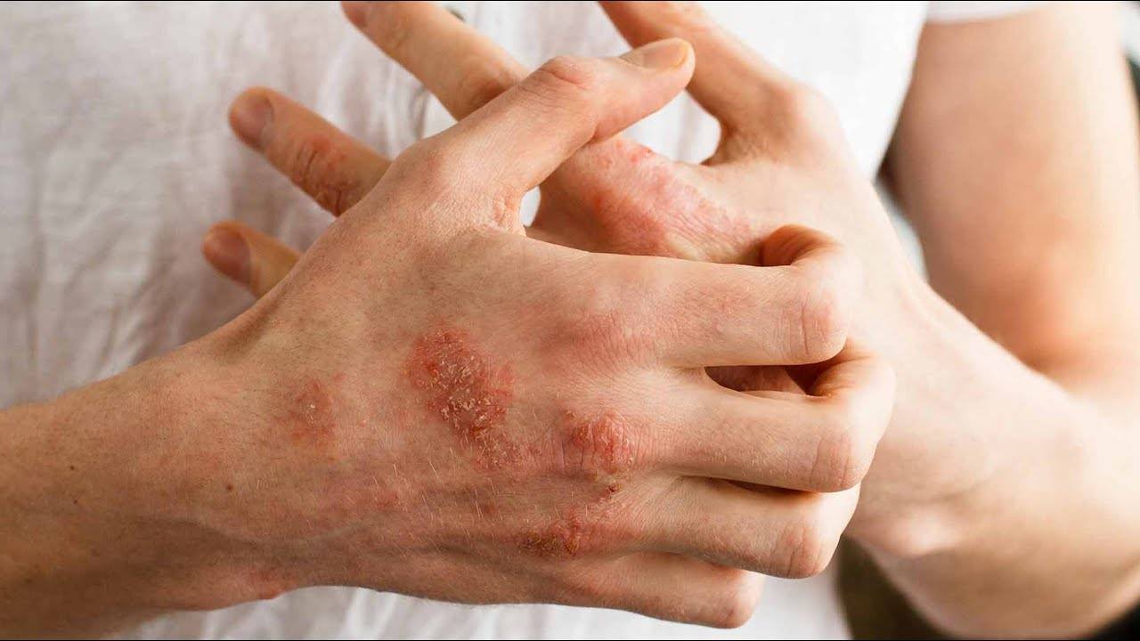 Зудящий дерматит: симптомы, лечение, лечение народными средствами. зудящий дерматит причины и лечение