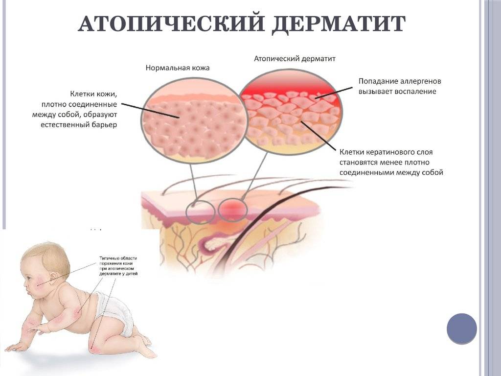 Причины и симптомы эксфолиативного дерматита, лечение