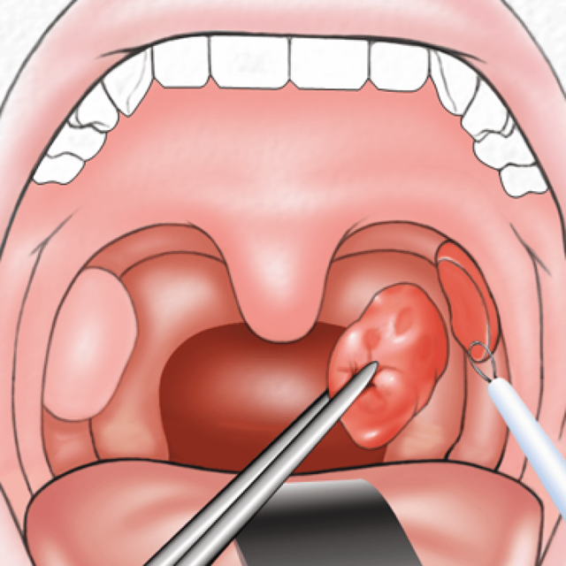Папиллома в горле: симптомы, типы и опасность заболевания