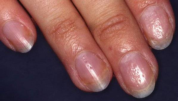 Псориаз ногтей на руках и ногах: причины, симптомы, лечение