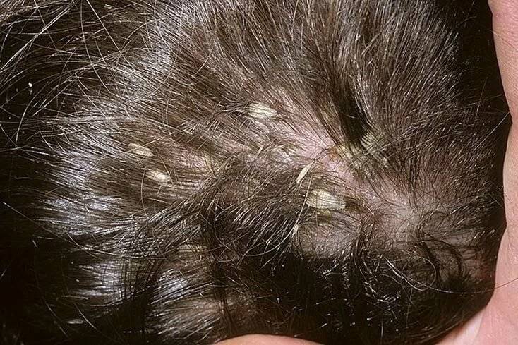 Псориаз волосистой части головы : причины, симптомы, диагностика, лечение