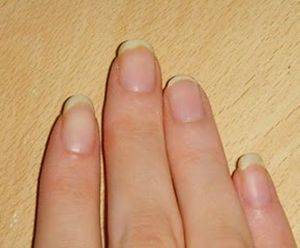 Причины пожелтения ногтей на руках и что делать