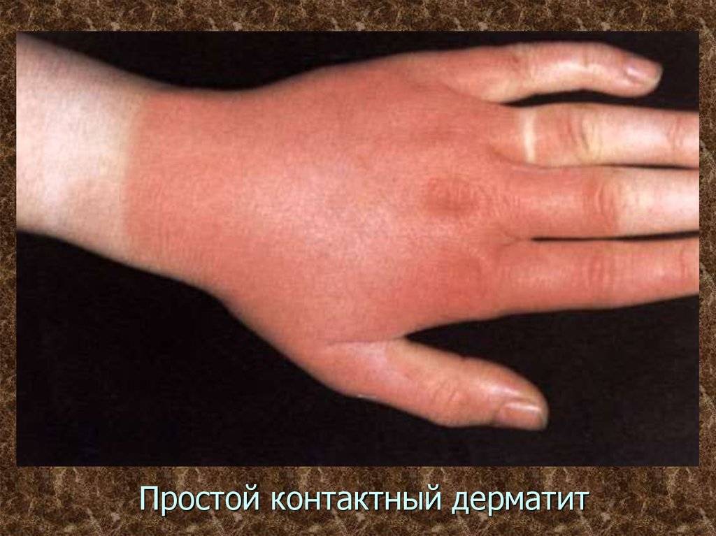 Виды кожных дерматитов