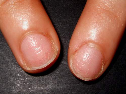 Псориаз ногтей, лечение и разновидности такого заболевания (фото)