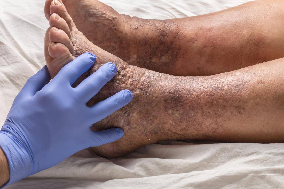Псориаз на ногах – как лечить, симптомы и причины заболевания