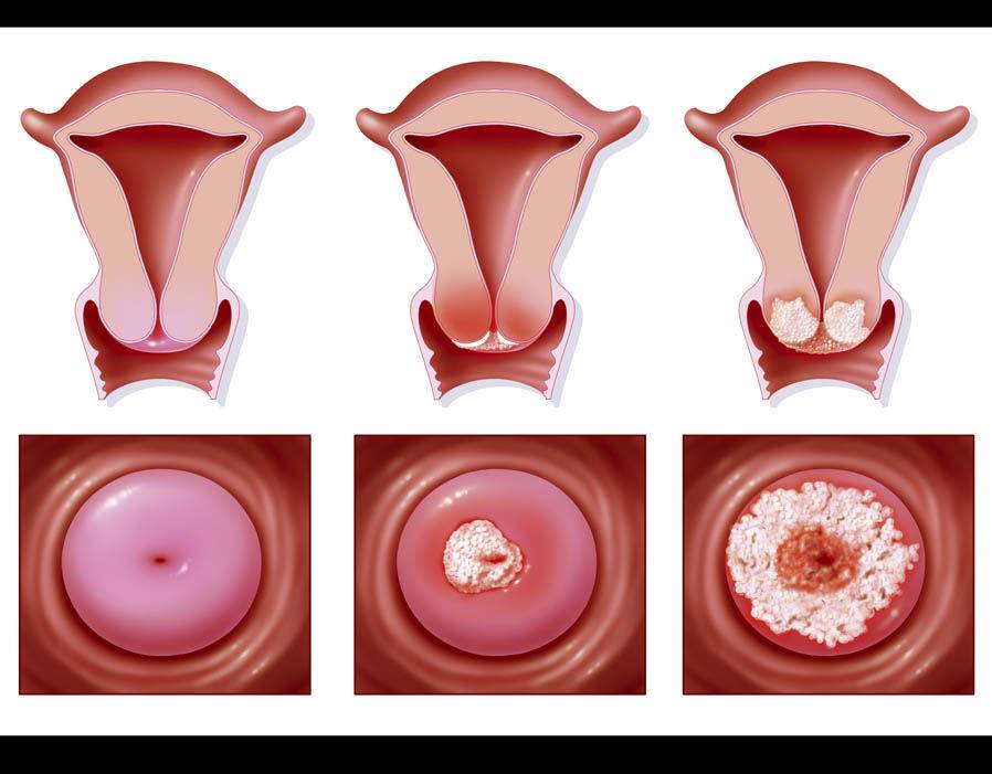 Как проявляется папиллома матки? как выглядит папилломатоз в полости матки? методы лечения болезни
