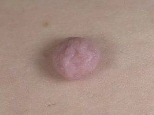 Папилломы под грудью: топ методов удаления без последствий