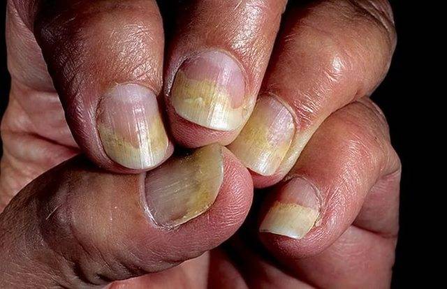 Фото и лечение псориаза ногтей традиционными и народными средствами