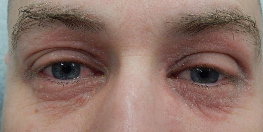 Ппориаз на глазах, в уголках и под глазами – симптомы и осложнения