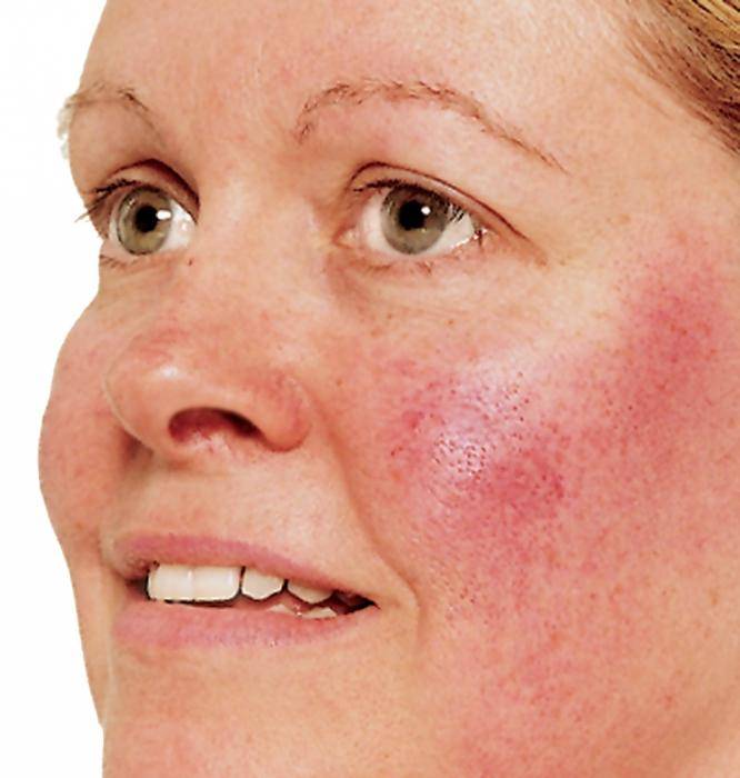Лечение псориаза на лице