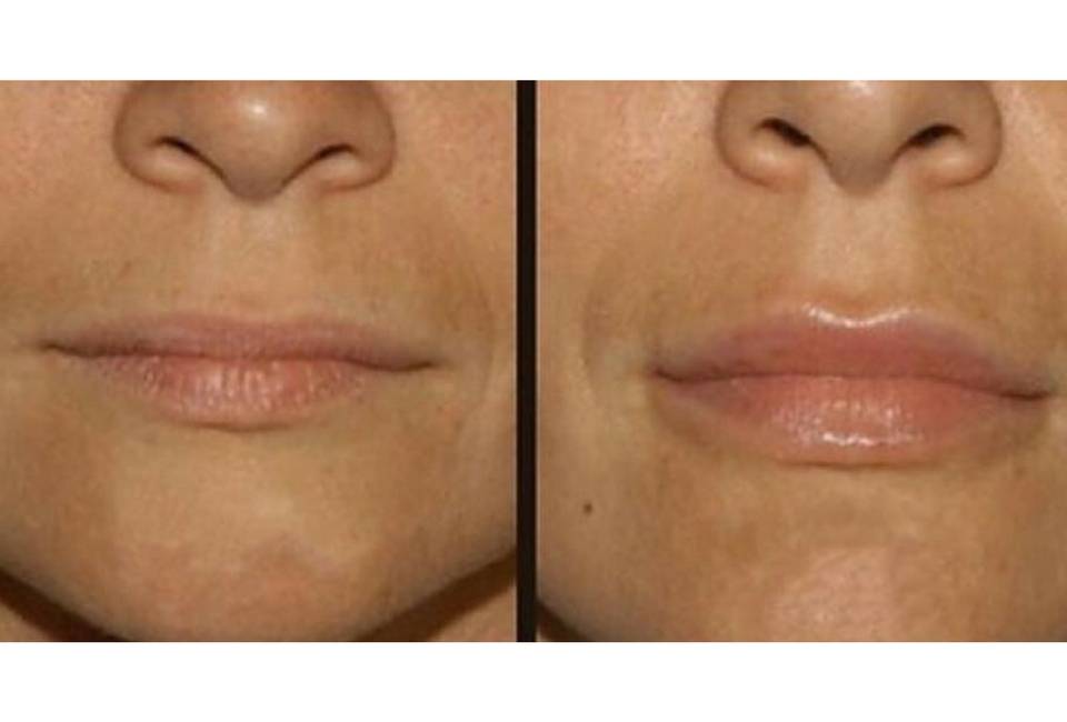 Липофилинг губ: цены, фото до и после, видео