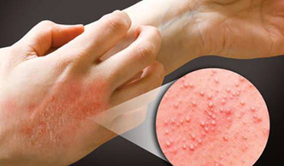 Буллезный дерматит пузырчатый:причины появления, разновидности, лечение