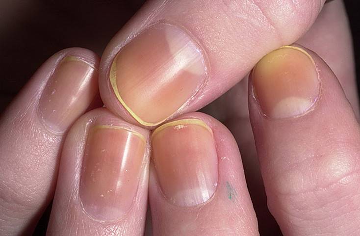 Причины желтизны ногтей на руках и способы ее устранения
