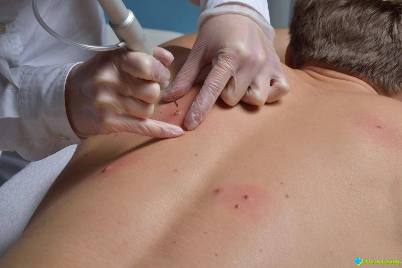 Папиллома на спине, причины лечение у мужчин и женщин