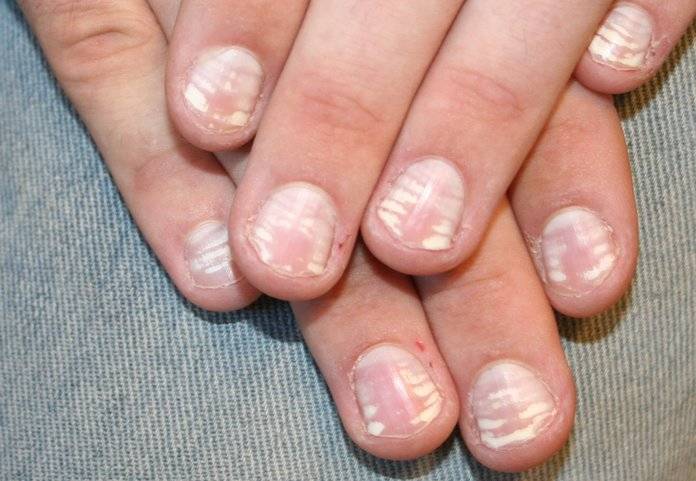 Причины появления полосок на ногтях