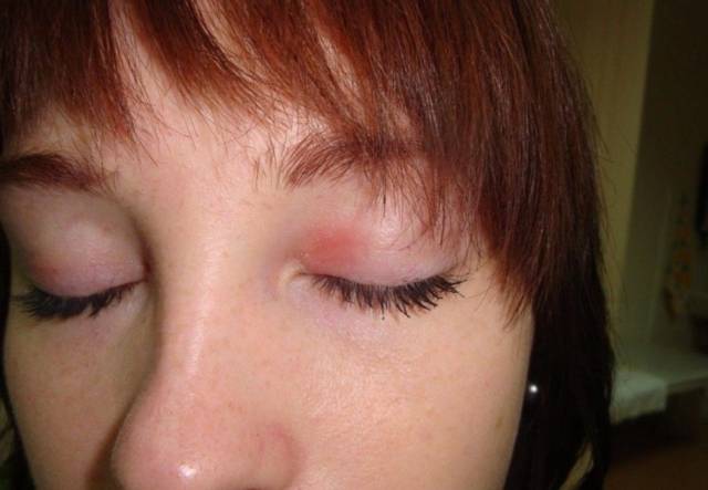 Причины, признаки и лечение псориаза на глазах. псориаз на глазах и веках: фото, лечение, причины симптомы