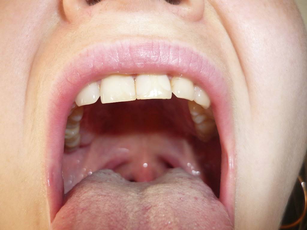Как выглядят папилломы в горле и способы их удаления