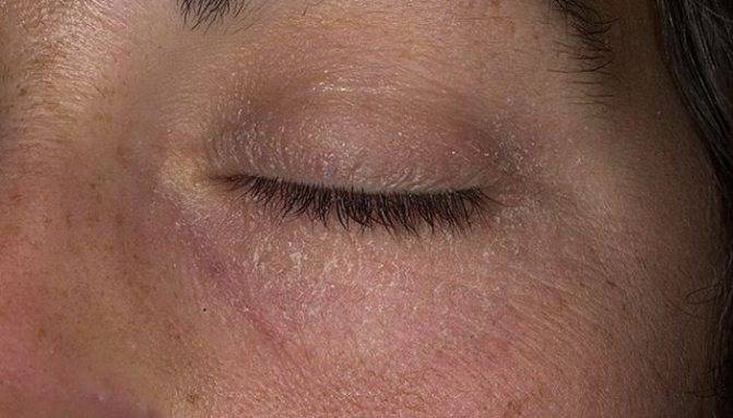 Псориаз на глазах: фото пораженных век, симптомы заболевания, сложности лечения