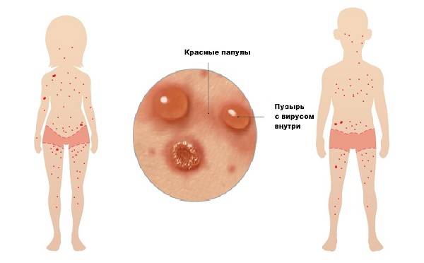 Опоясывающий лишай у детей: как выглядит на фото, причины и симптомы, через сколько пройдет, лечение | pro-herpes.ru