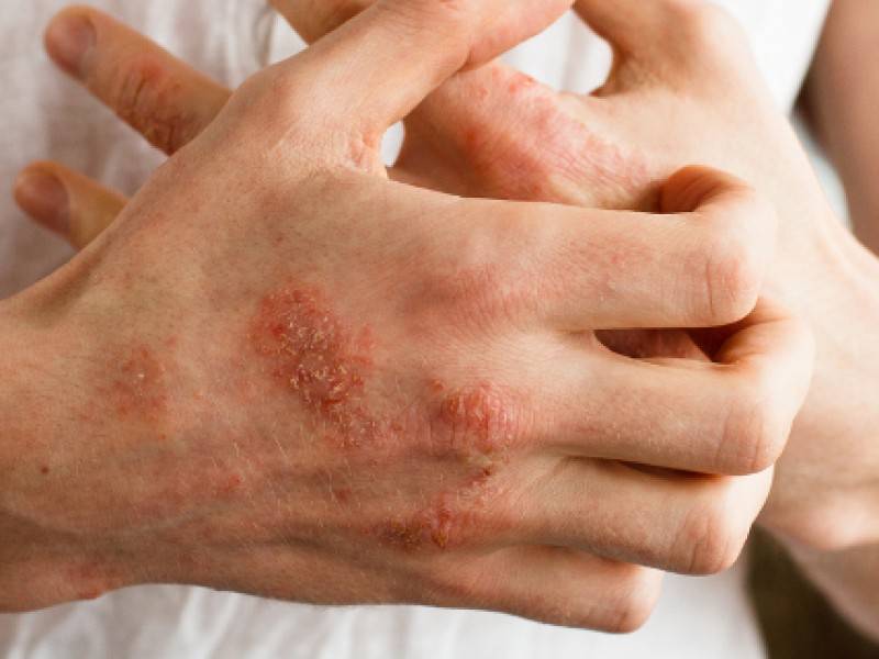 Пузырчатый дерматит - причины, симптомы и лечение (фото) 2020