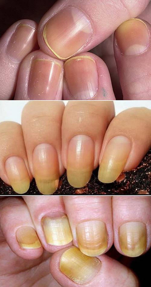 Почему на ногтях желтизна. желтые ногти на руках: причины заболевания и бытовые проблемы.